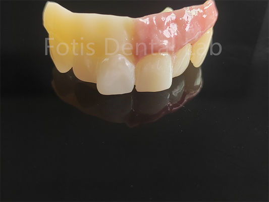 Monolit Zirconia Berlapis Dengan Porselen Desain Dibantu Komputer