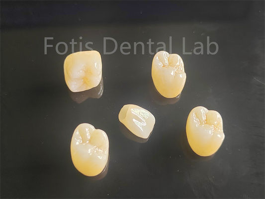 Apelasi Estetika Full Porcelain Lapisan Zirconia Ideal Untuk Jembatan Mahkota