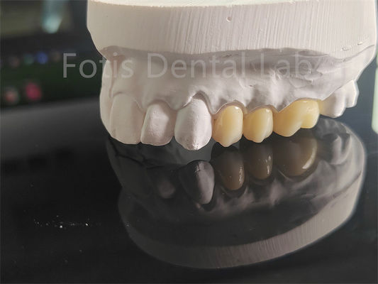 Tinggi Kekuatan Full Porcelain Lapisan Zirconia Untuk Mahkota Gigi