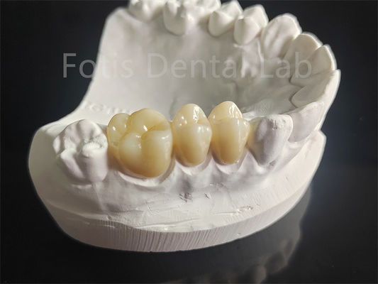 Ketahanan Pakai Zirconia Lapisan Dengan Bahan Gigi Porselen