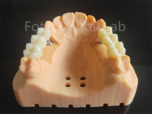 Disesuaikan Zirconia Full Contour berlapis dengan bahan gigi porselen