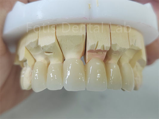 Produk Gigi Zirconia Lapisan Dengan Porselen Perbaikan Mudah