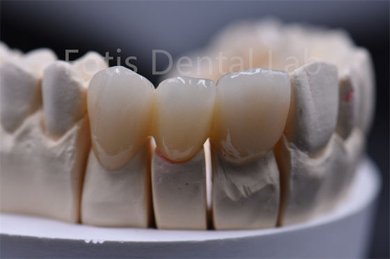 Bahan gigi keramik zirconia multilayer tebal yang dapat disesuaikan