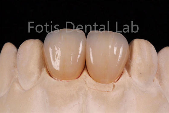 Zirconia Berlapis Berlubang Tinggi Untuk Pembuatan Restorasi Gigi