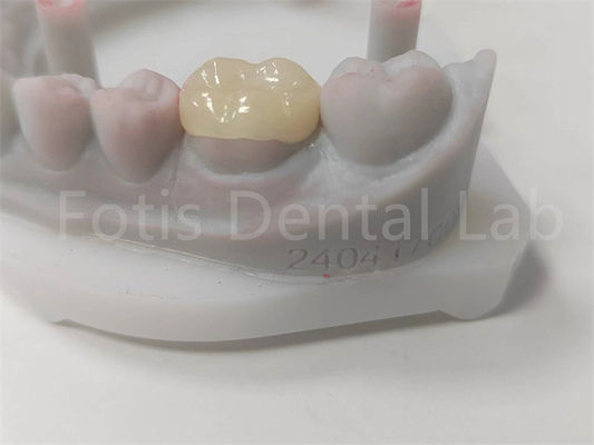 OEM Inlay Gigi Dan Onlay Restorasi Keramik Dan Isi Berwarna Gigi