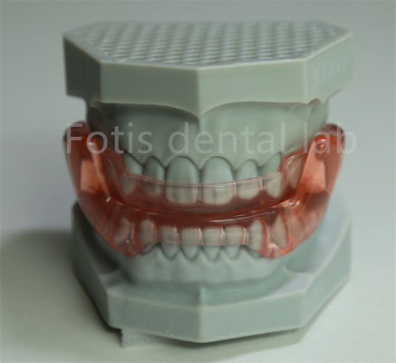 OEM Orthodontic Retainer Expander Semua Ukuran Kompatibel Dengan Sebagian Besar Perawatan Ortodontik