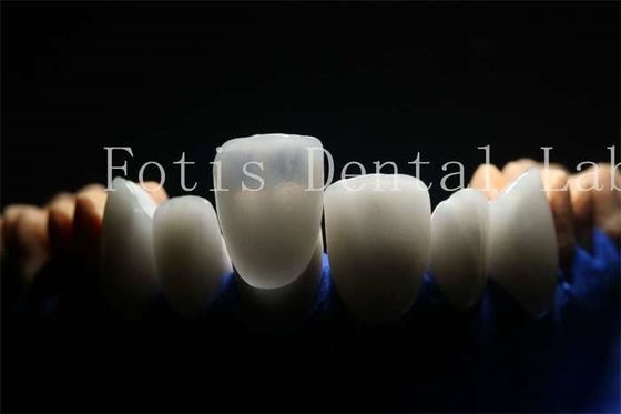 Laminasi Prosthetic veneer yang tahan lama dan tahan lama dengan bahan porselen