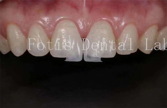 Laminasi Laminasi Laboratorium Gigi Translucence Tinggi untuk Pengolahan Alam dan Polishing