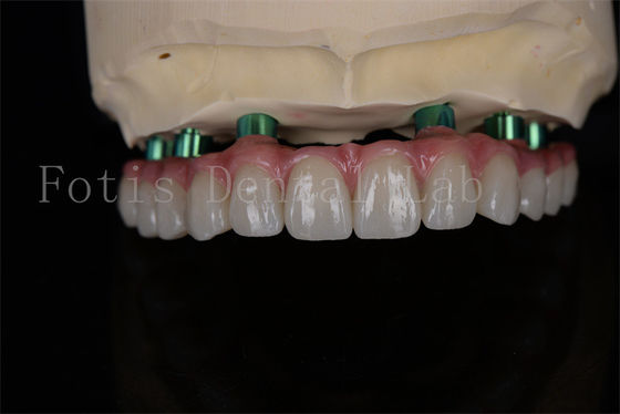 Prosedur implan Zirconia All-on-4 pada hari yang sama pemulihan minimal tindak lanjut diperlukan